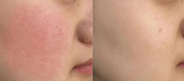 Model's skin after Flyode mask