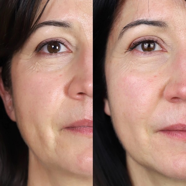 Visibly lifted skin after Flyode mask