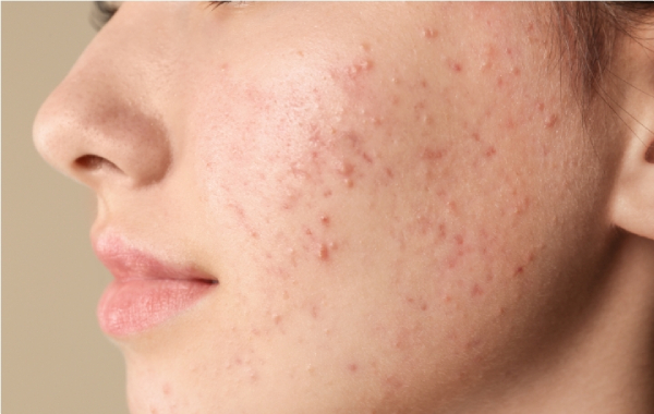 Sensitive skin needing soothing