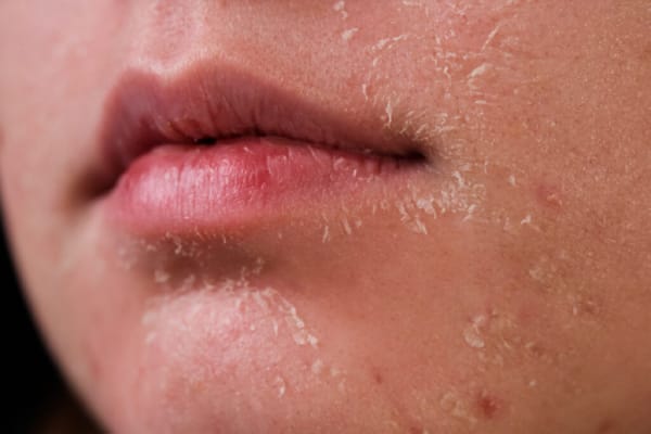 Signs of Damaged Skin Barrier - Redness, Dryness, Sensitivity