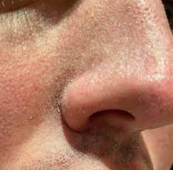 Dead Skin Cell Buildup - Cause of Dull Skin